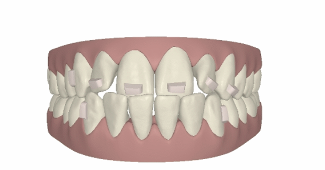 Patientin Beispiel Twin Block, Invisalign®