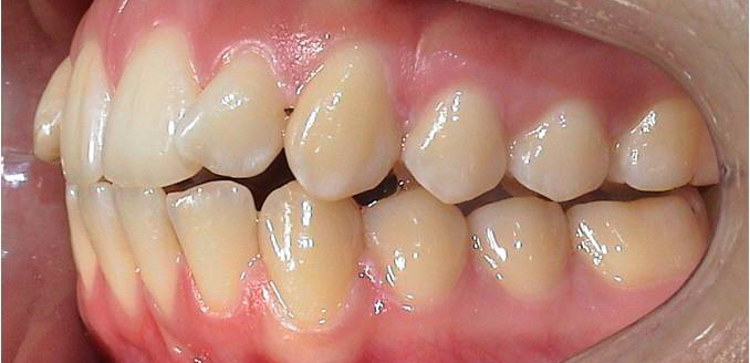 Behandlung Aligner und Twin Block