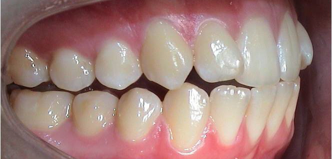 Vor Behandlung Twin-Block Invisalign®