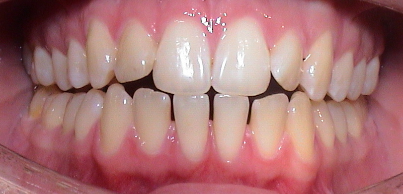 Twin-Block Invisalign® Therapie