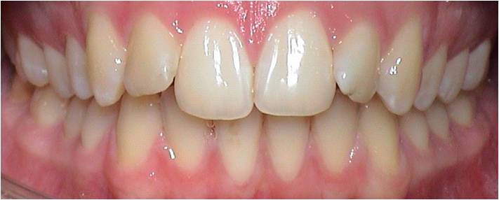 Invisalign® Deckbiss Therapie