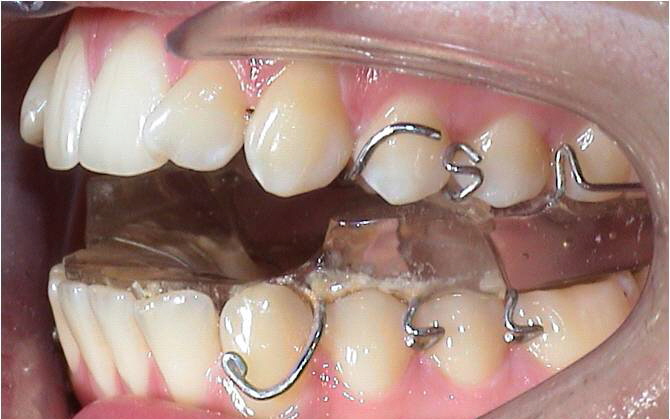 Behandlung Twin-Block