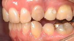 Extraktion von Zähnen Lückenschluss 