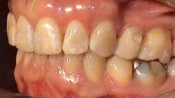 Nach Invisalign Behandlung 