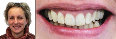 Nach Behandlung Zähne ziehen