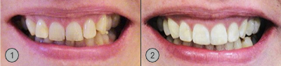 Vor und Nachher Bilder Zahnextraktion Zähne ziehen Patientenbeispiel