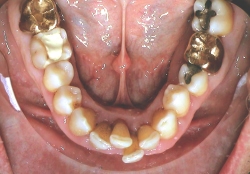 Invisalign® Zahnfleischentzündung Therapie