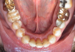 Behandlung der Zahnfleischentzündung
