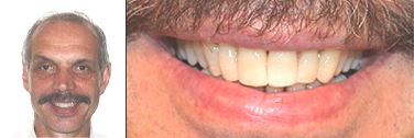 Nach Behandlung Zahnfleischentzündung