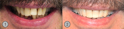 Vor und Nachher Bilder Zahnfleischentzündung Ginigvitis Patientenbeispiel