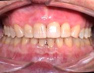 Behandlungsergebnis Zahnlücken geschlossen