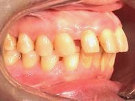 Vor Behandlung Zahnlücken Bilder