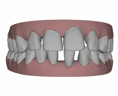 Patientin Beispiel Zahnlücken, Invisalign®