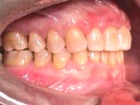 Invisalign Parodontits nach Behandlung