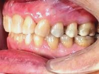Nach Invisalign® Therapie