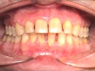 Invisalign® Parodontose Therapie