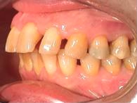 Behandlung der Zahnlücke