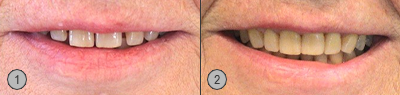 Vor und Nachher Bilder Zahnlücken Parodontitis Patientenbeispiel
