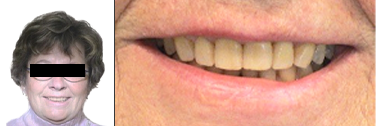 Nach Behandlung Zahnlücken