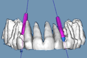 Patientin Beispiel Nichtanlage, Invisalign®