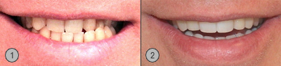 Vor und Nachher Bilder Nichtanlage Zahnimplantate Patientenbeispiel
