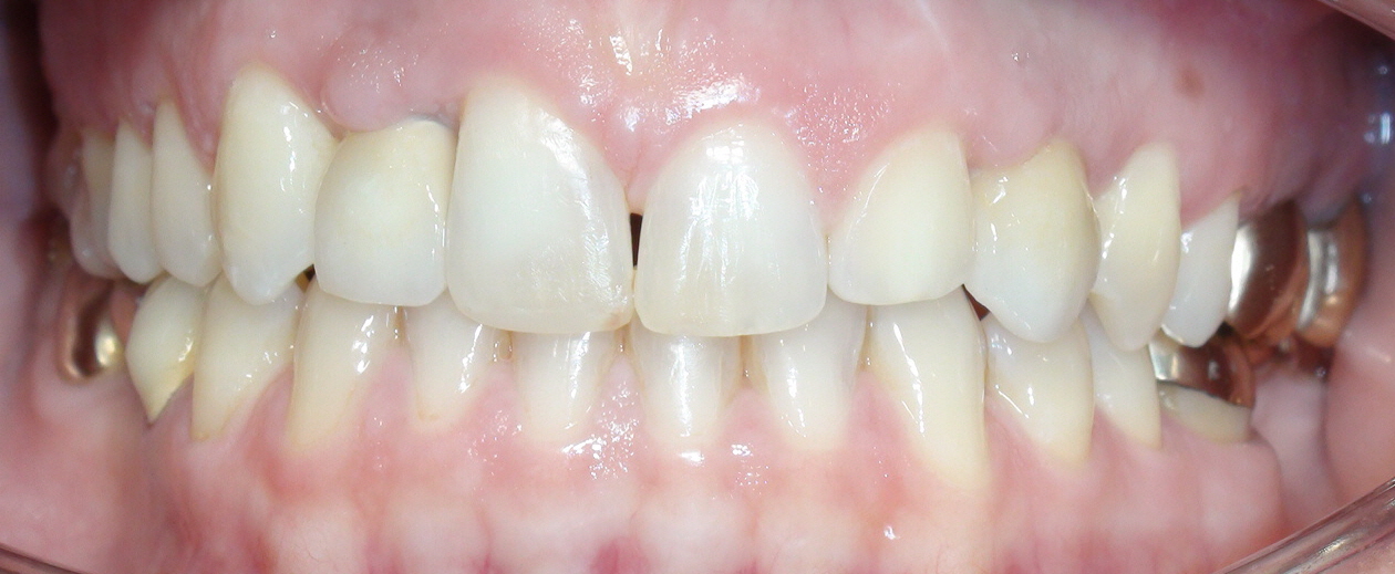 Nach Behandlung Fronzahnimplantat und Invisalign®