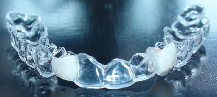 Invisalign® Therapie Aligner Schiene