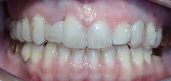 Zahnlückenschluß mit Invisalign und einem Zahnimplantat