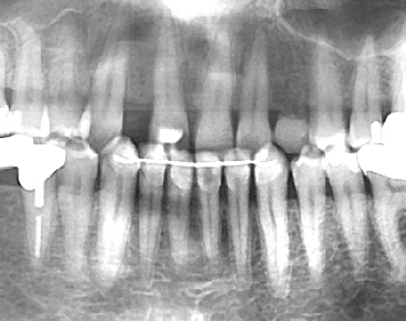 Nach Behandlung Invisalign® Röntgenaufnahme