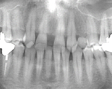 Vor Behandlung Invisalign®  Röntgenaufnahme