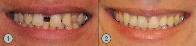 Vor und Nachher Bilder Implantat Patientenbeispiel