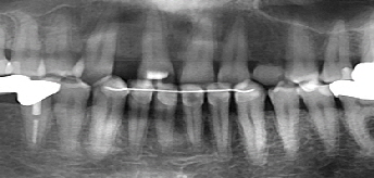 Zahnlückenschluß mit Invisalign® und Implantat