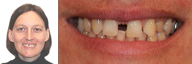 Vor Behandlung der Zahnlücke