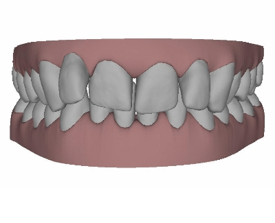 Invisalign® Clin-Chek 