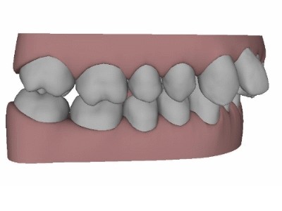 Invisalign® Planung Clin-Chek 