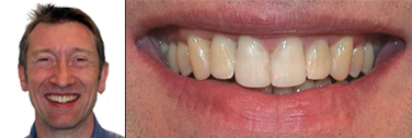 Nach Behandlung Dysgnathie und Invisalign