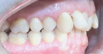 Dysgnathie und Invisalign® Tiefer Biss, Unterkieferrücklage