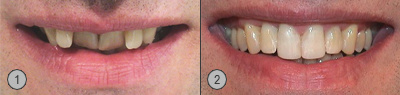 Patientenbeispiel Vor und Nachher Bilder Deckbiss/Retrogenie Korrektur Invisalign® 