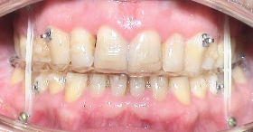 Behandlung mit Invisalign® Aligner und Gummizüge