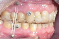 Dysgnathie und Invisalign Behandlung mit Invisalign® Aligner