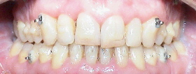 Patient ohne Invisalign® Aligner und Gummizüge