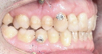Dysgnathie und Invisalign ohne Schienen