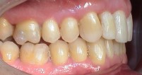 Nach Dysgnathie und Invisalign Therapie