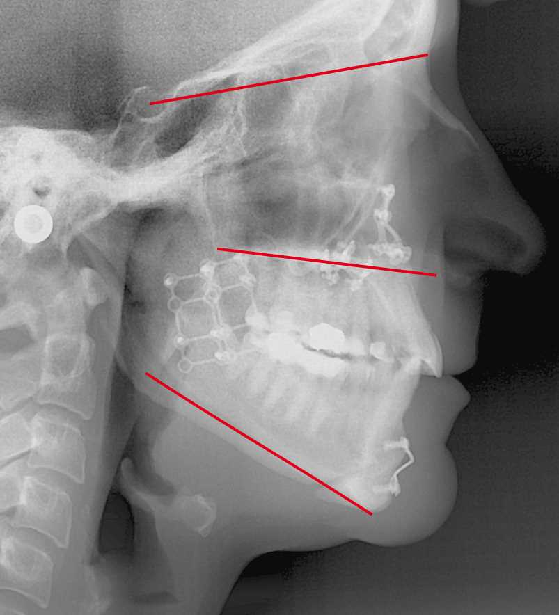 Invisaligntherapie und kieferchirurgischen Eingriff