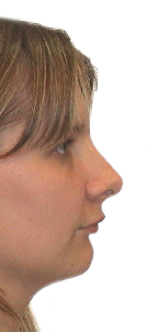 Vor Behandlung Laterognathie  Invisalign und OP