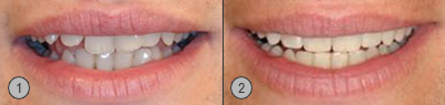 Vor und Nachher Bilder Patientenbeispiel Gummizüge