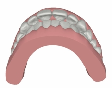 Behandlungsbild Clin Check Behandlung Invisalign
