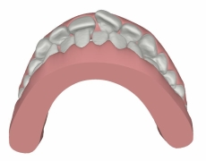 Clin Check Behandlungsbild Invisalign Teen Oberkiefer Front 