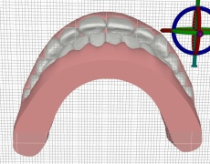 Invisalign Teen Behandlungsende