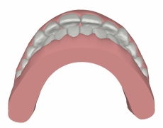 Clin Check Invisalign Teen